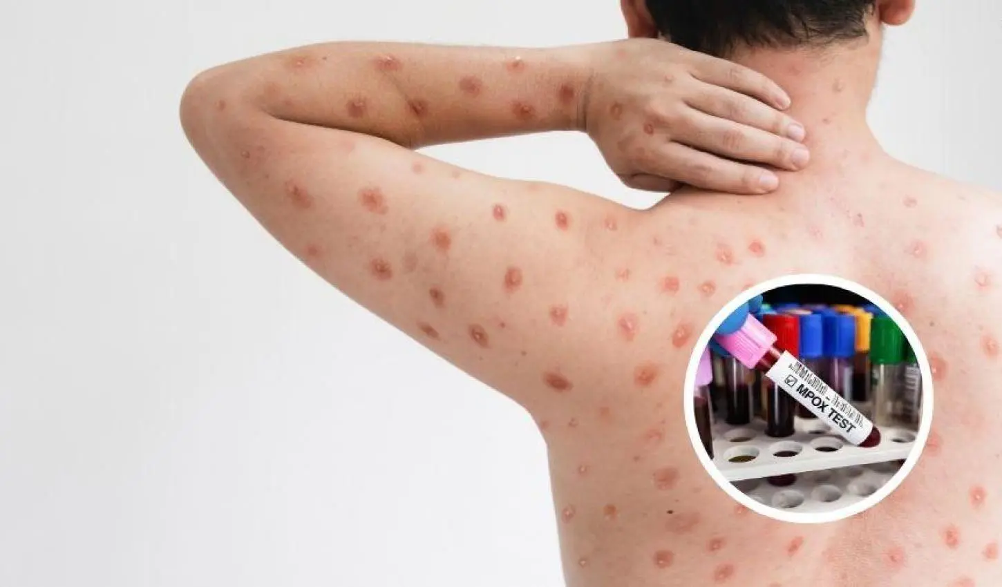 Surge nova variante da varíola mpox em 2 países, admite OMS