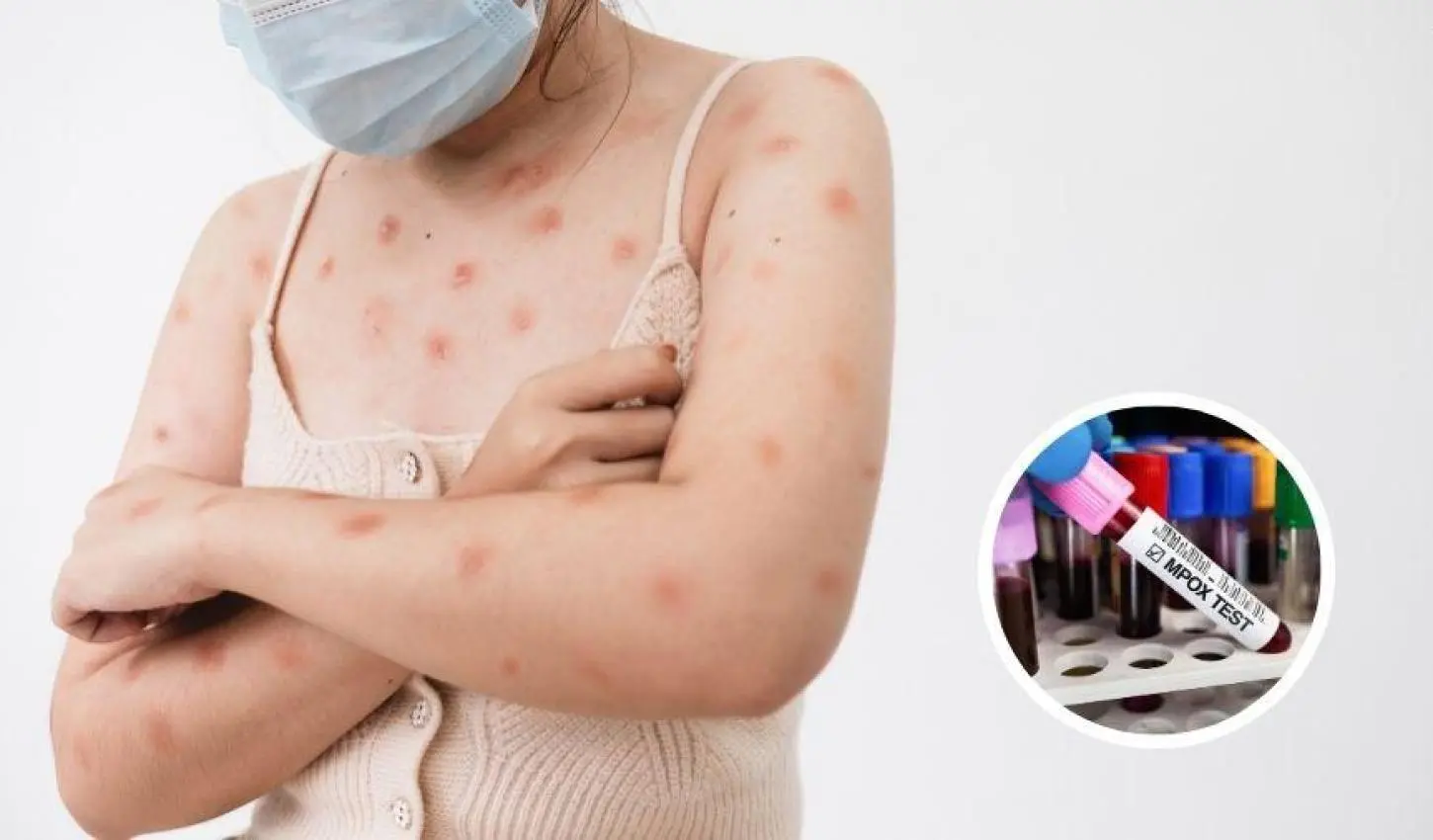 O que saber sobre a mpox, que já supera 80 casos no Brasil